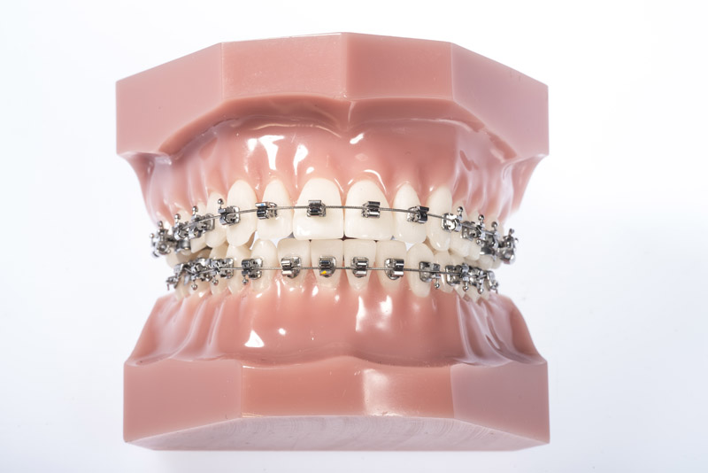 Multiband (selbstligierende Brackets)